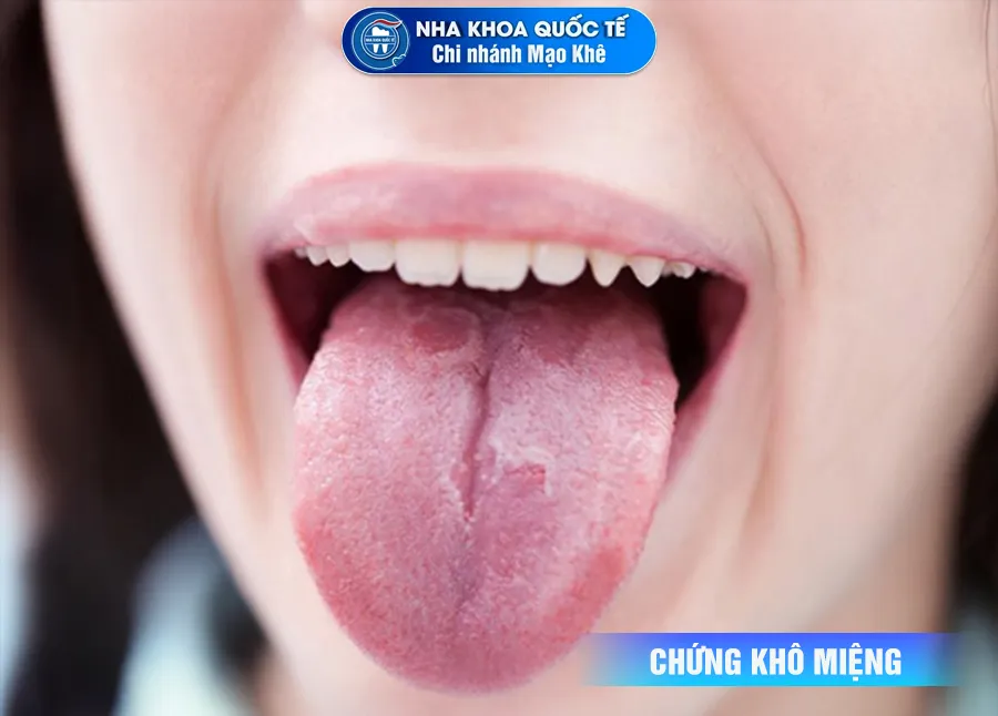 CHỨNG KHÔ miệng