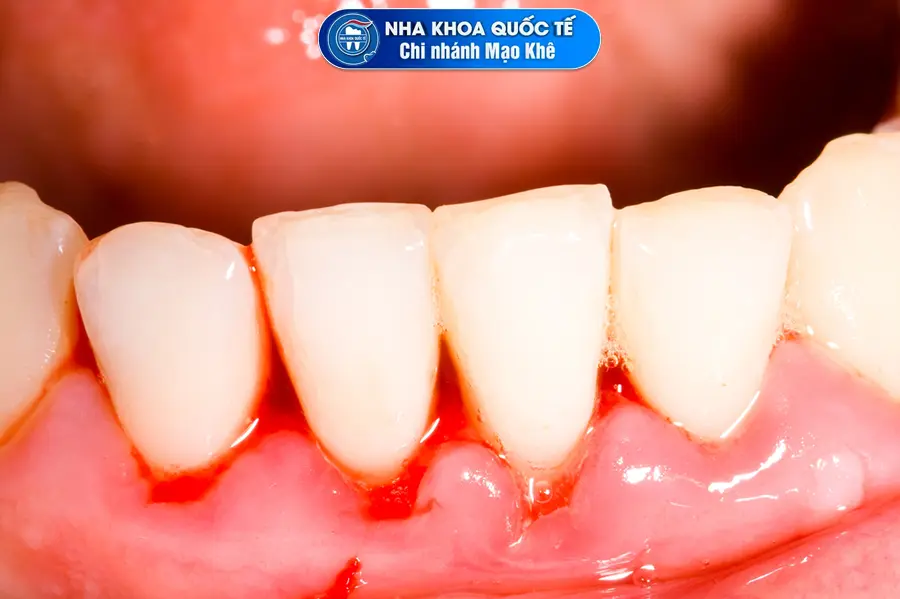 hiện tượng chảy máu chân răng