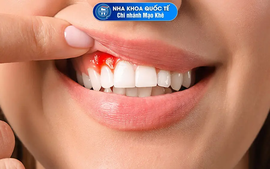 tổn thương nướu