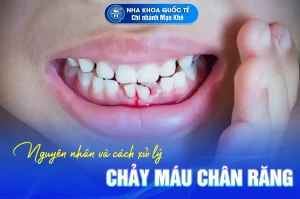 xử lý chảy máu chân răng