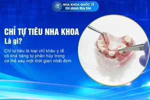 chỉ tự tiêu nha khoa