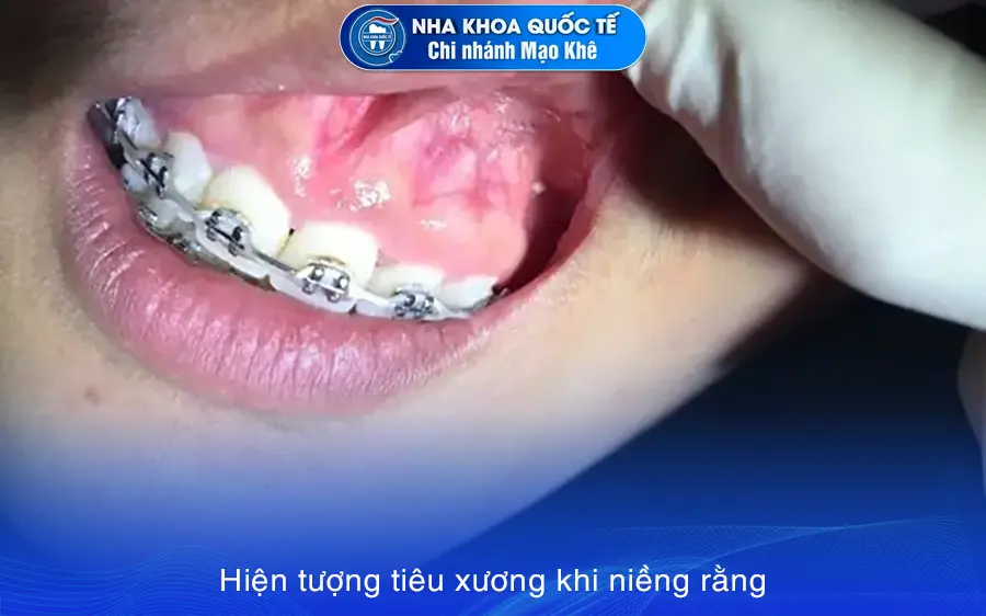 niềng răng tiêu xương 2