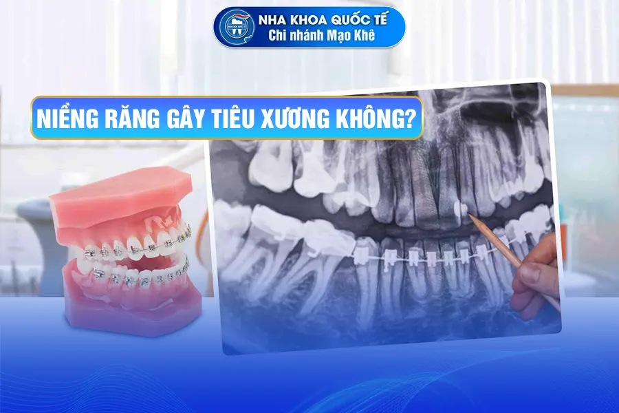 niềng răng tiêu xương