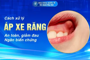 xử lý áp xe răng