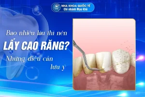 bao lâu lấy cao răng