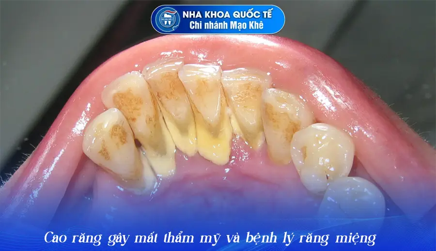 cao răng là gì