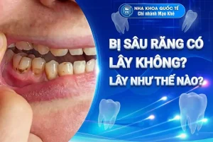 sâu răng có lây không