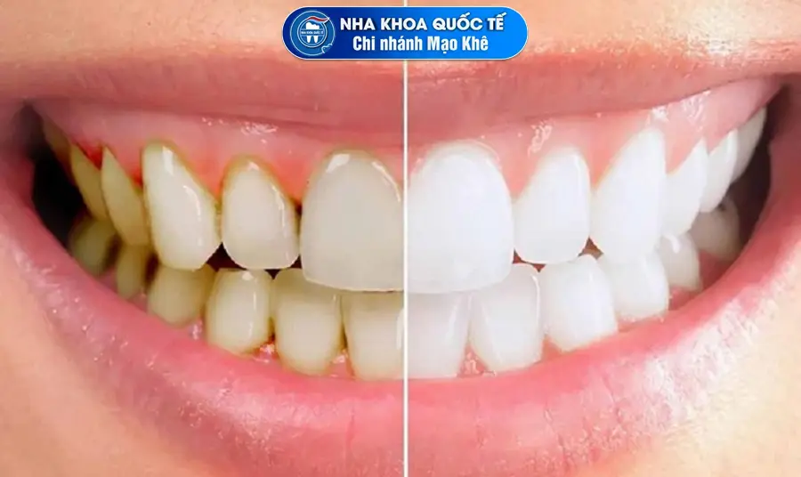 tác dụng lấy cao răng