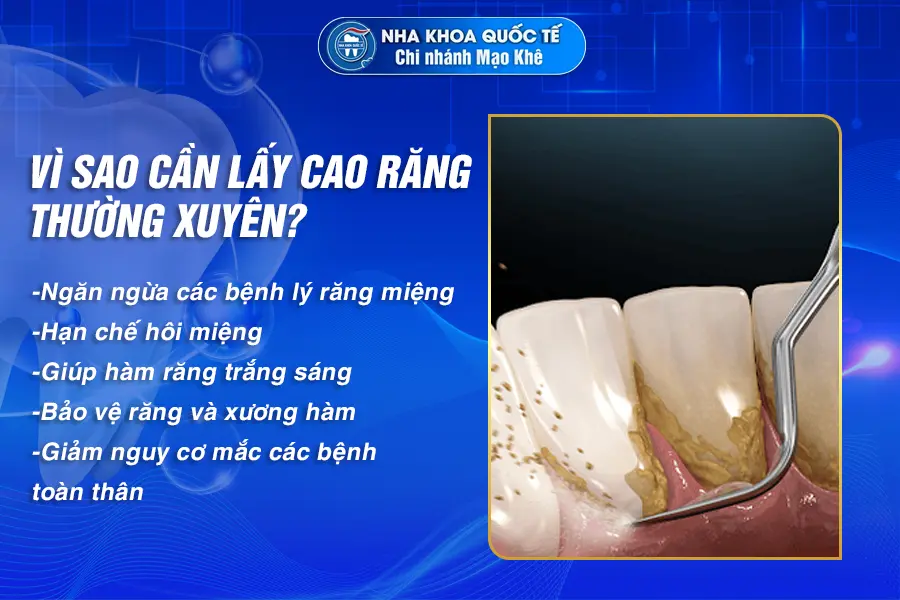 vì sao nên lấy cao răng