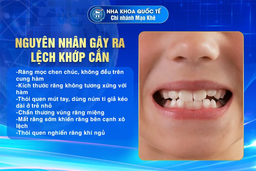 Nguyên nhân gây lệch khớp cắn