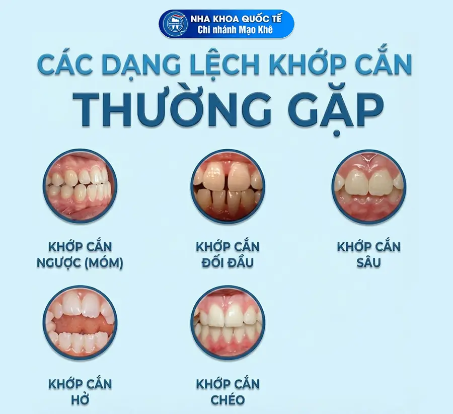 các loại lệch khớp cắn