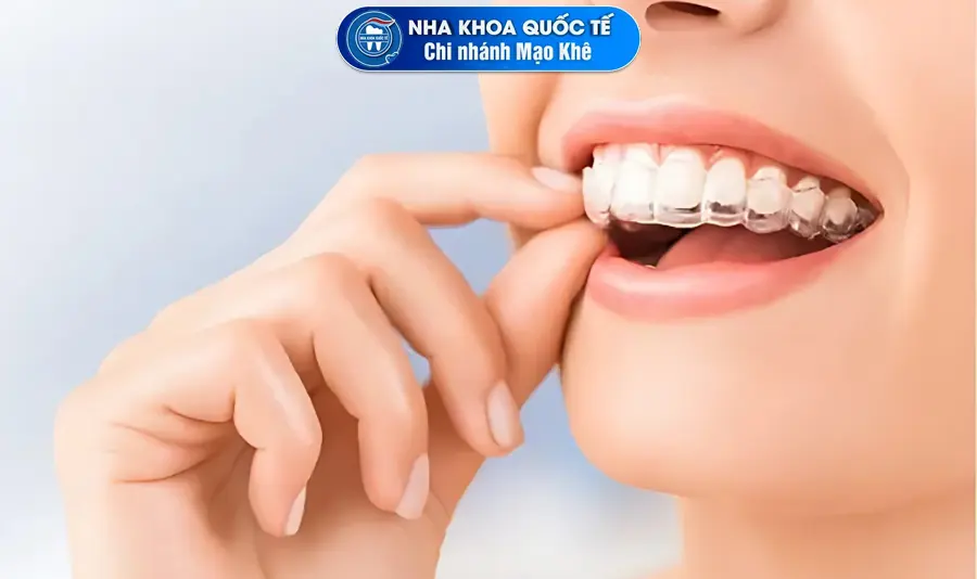 Khay niềng răng-invisalign