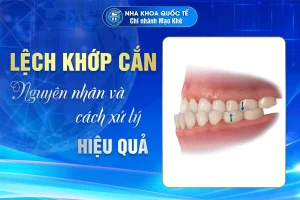 lệch khớp cắn là gì