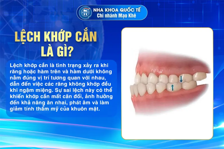 lệch khớp cắn là gì