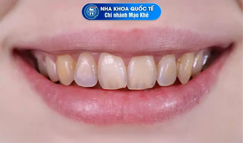 Răng ố vàng gây mất thẩm mỹ