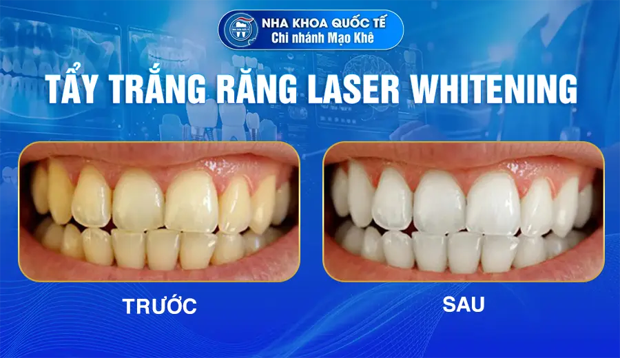 tẩy trắng răng ở mạo khê