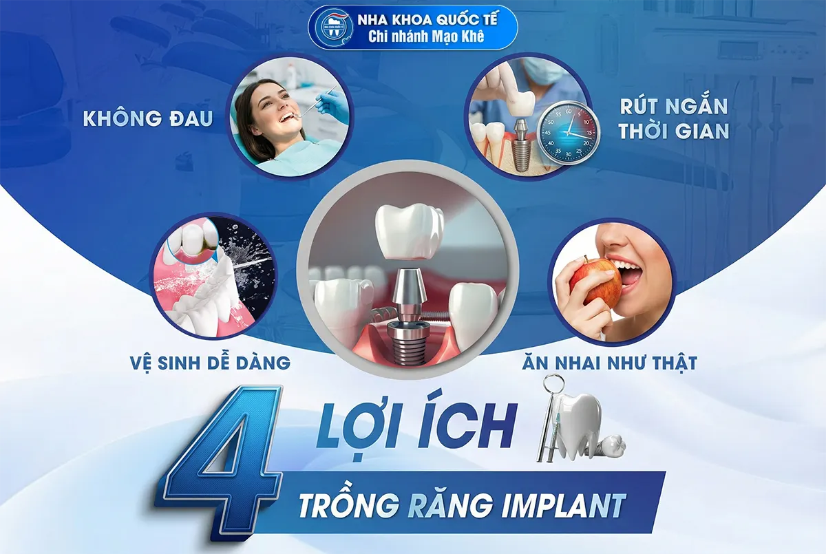 4 lợi ích trồng implant