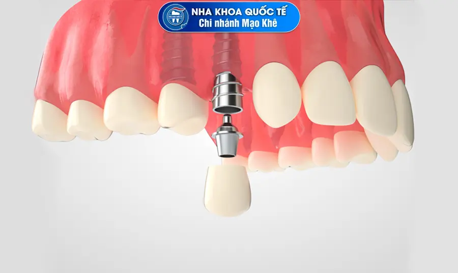 implant đơn lẻ