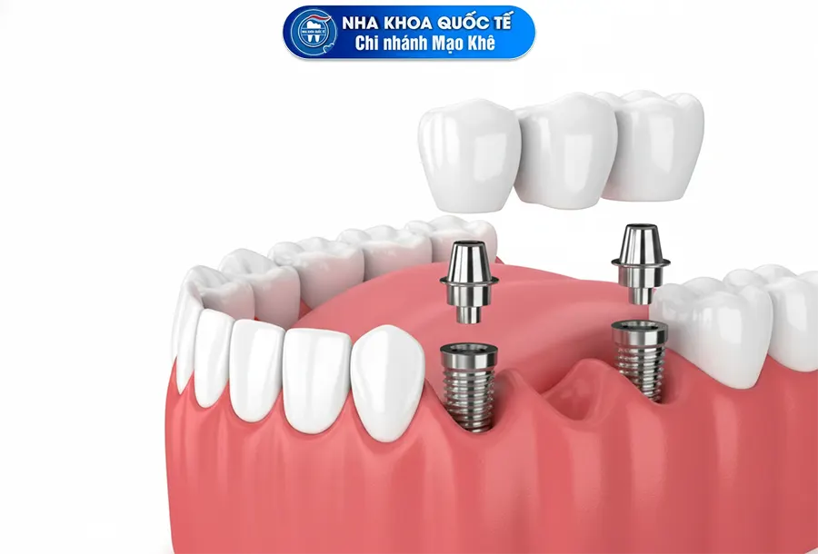 Trồng implant bắc cầu