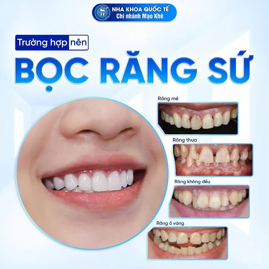 trường hợp nên bọc răng sứ