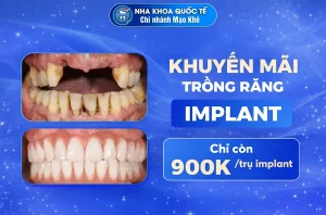khuyến mãi trồng răng implant 900k
