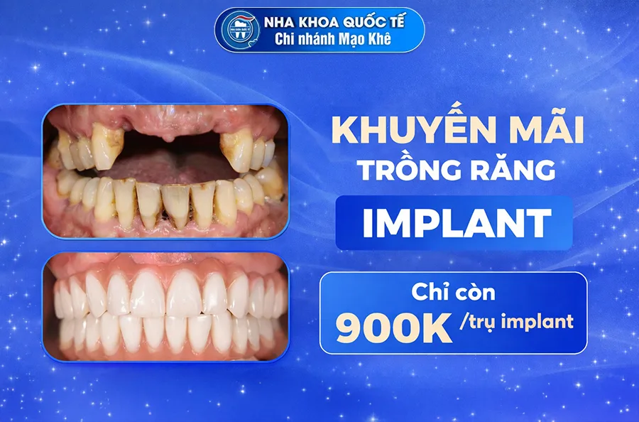 khuyến mãi trồng răng implant 900k