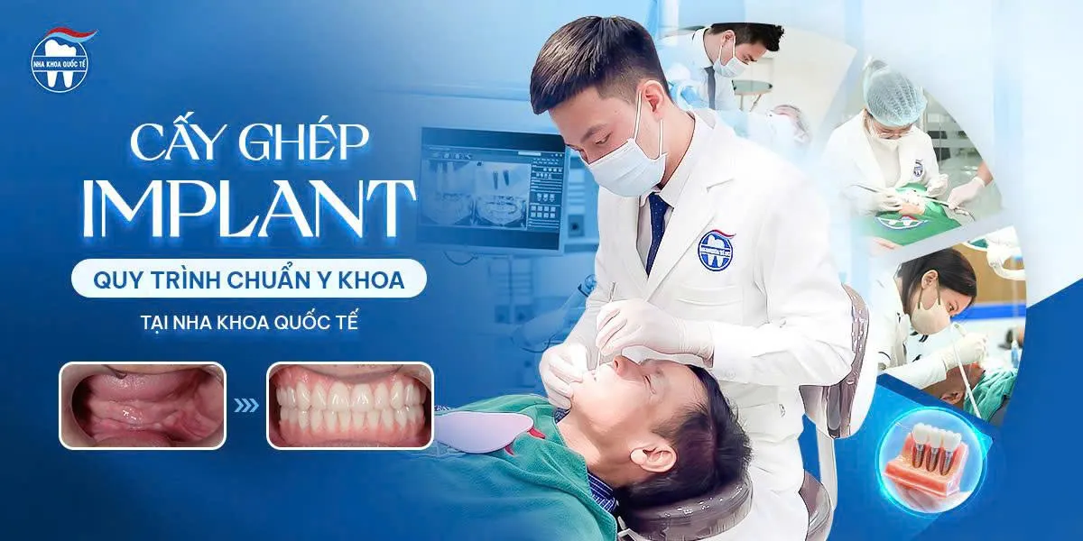 quy trinh cấy implant