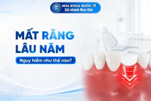 Mất răng lâu năm có nguy hiểm không