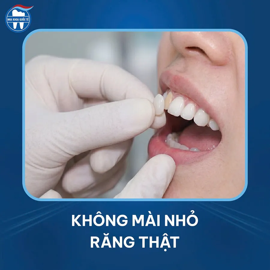 Không mài nhỏ răng thật