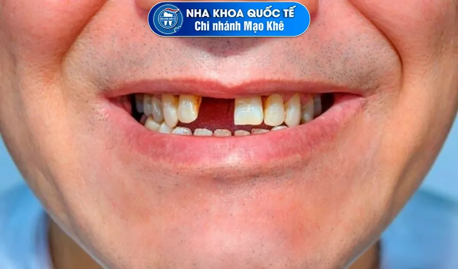 mất răng cửa ảnh hưởng thẩm mỹ