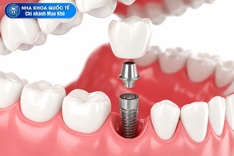 trồng implant như nào