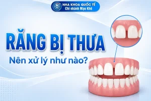 xử lý răng thưa như nào