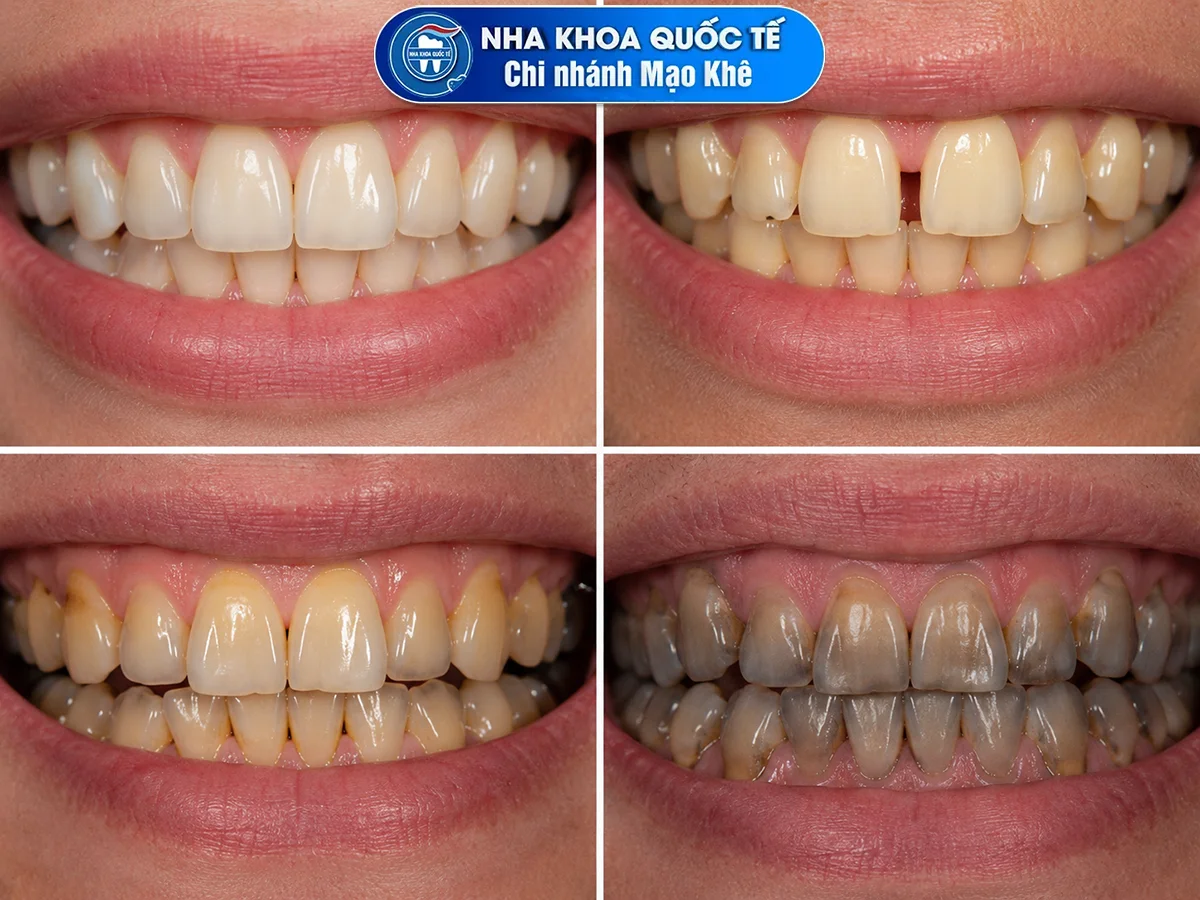 các mức độ nhiễm màu của răng