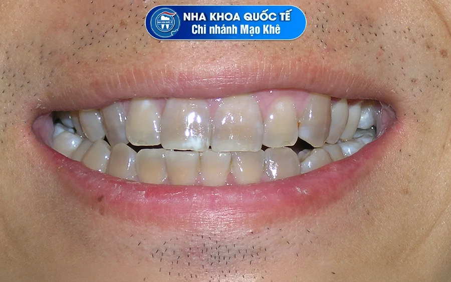 răng nhiễm tetracycline