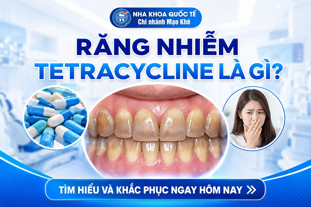 răng nhiễm tetracyline là gì