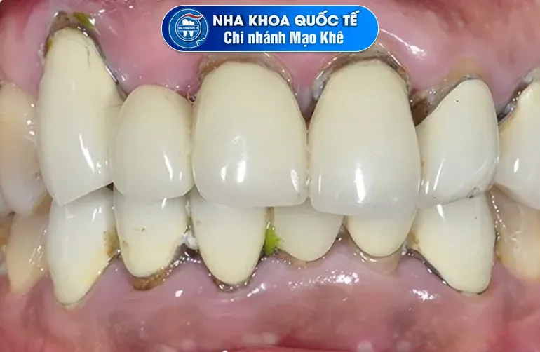 răng sứ hỏng kém chất lượng