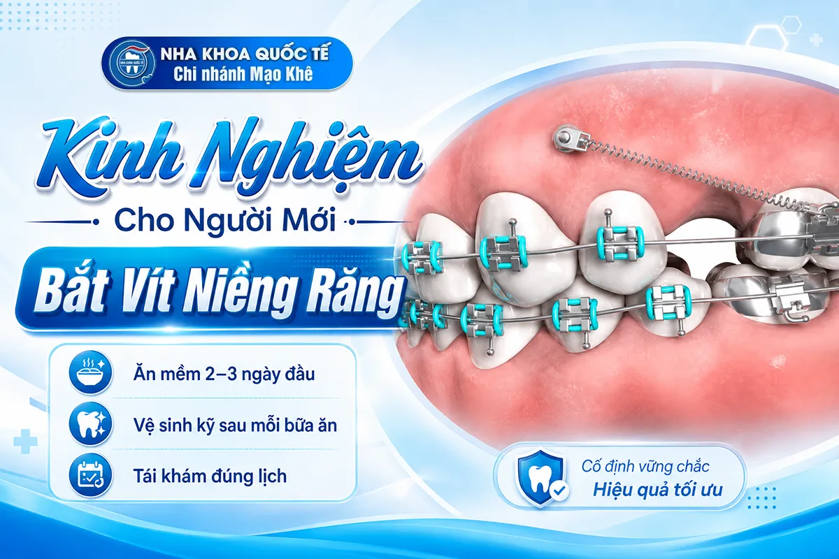 kinh nghiệp cho người mới bắt vít niềng răng