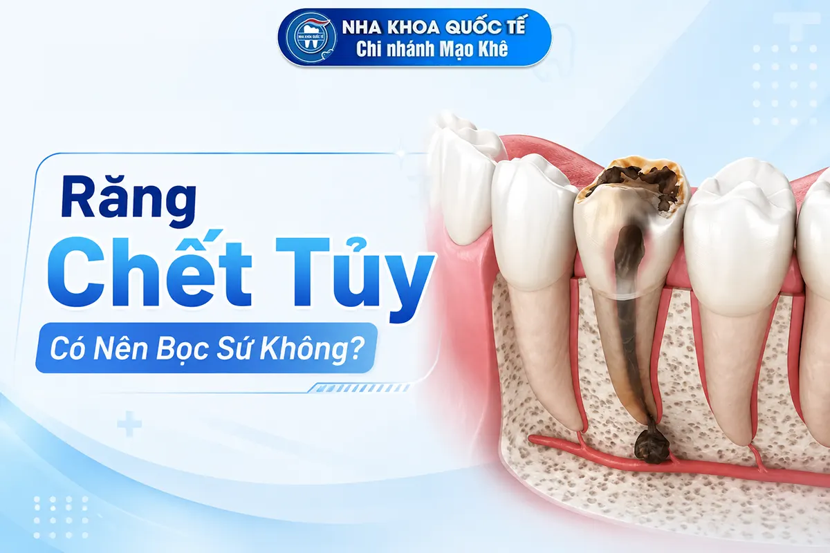 Răng chết tủy nên bọc sứ không