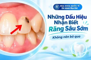 dấu hiệu sâu răng sớm