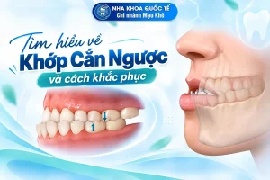khớp cắn ngược là gì