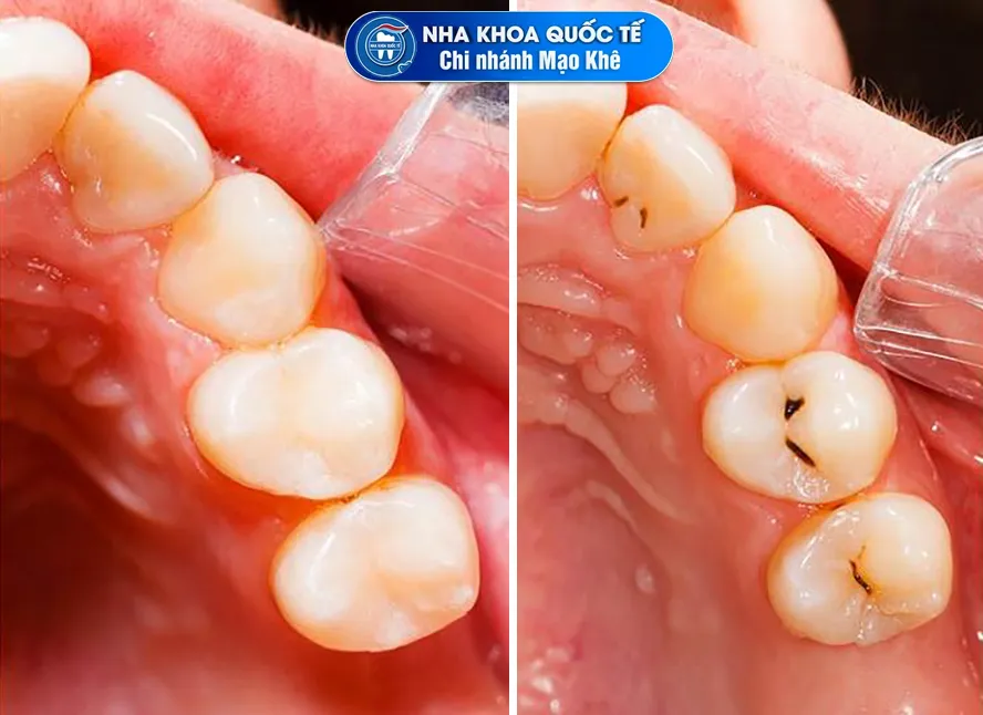 răng bị sâu nhẹ