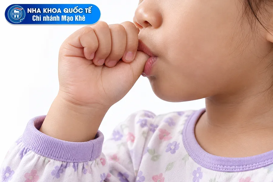 thói quen mút tay làm khớp cắn ngược